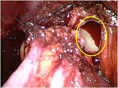Case Report: How an Iliac Vein Lesion During Totally Endoscopic Preperitoneal Repair of an Inguinal Hernia Can Be Safely Managed